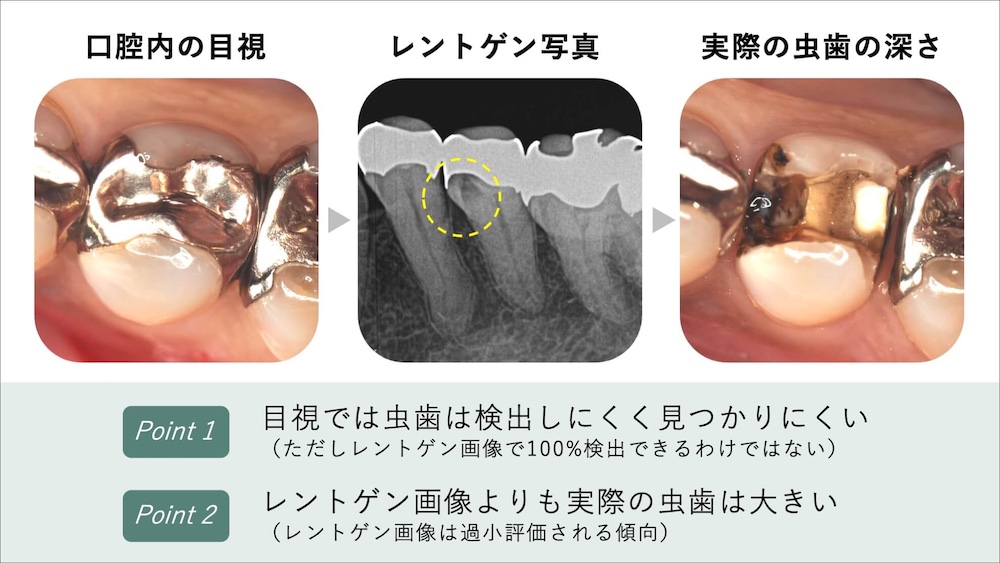 検査結果より実際の銀歯の下の状態はさらに悪いことが多い