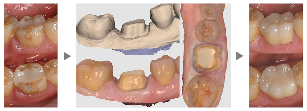 ⑦クラウンを装着