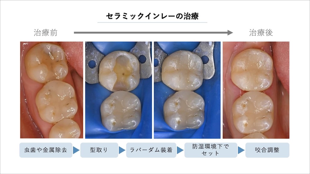 詰め物(インレー)で治療する場合