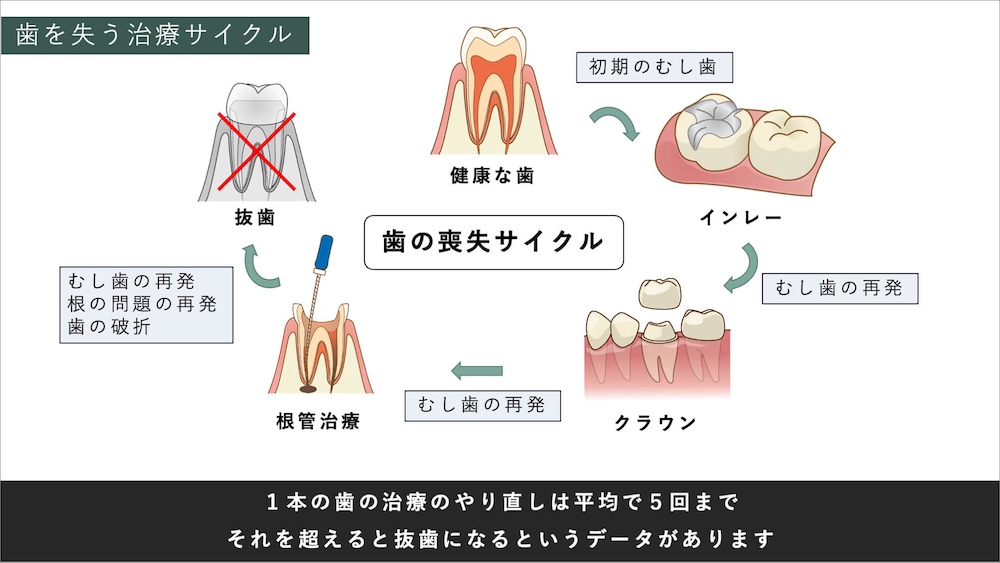 再治療が遅れるほど歯を失うリスクが高まる