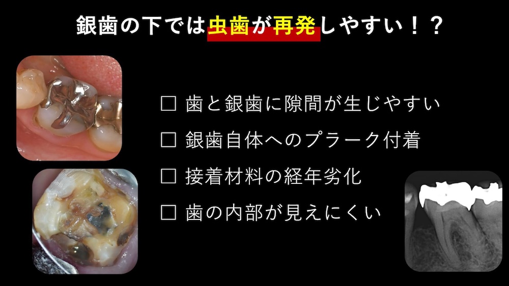 銀歯の下で虫歯が起こる理由:二次う蝕とは