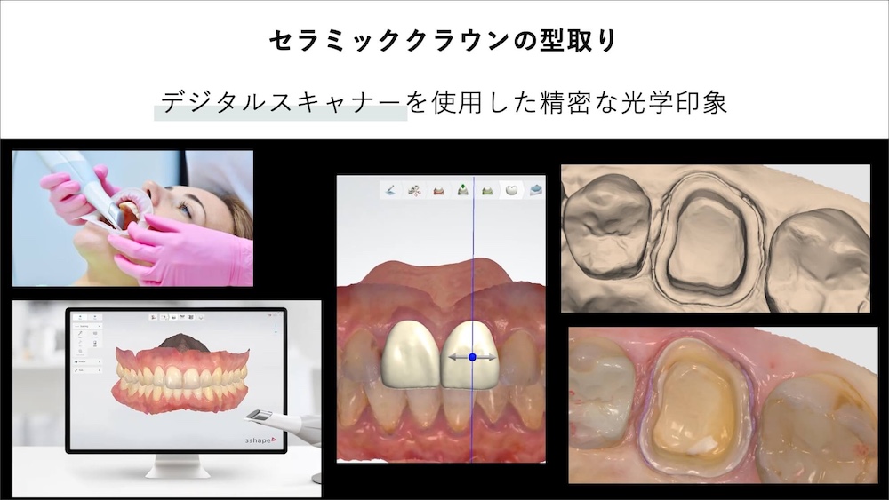 ⑤デジタルスキャナーによる精密な光学印象