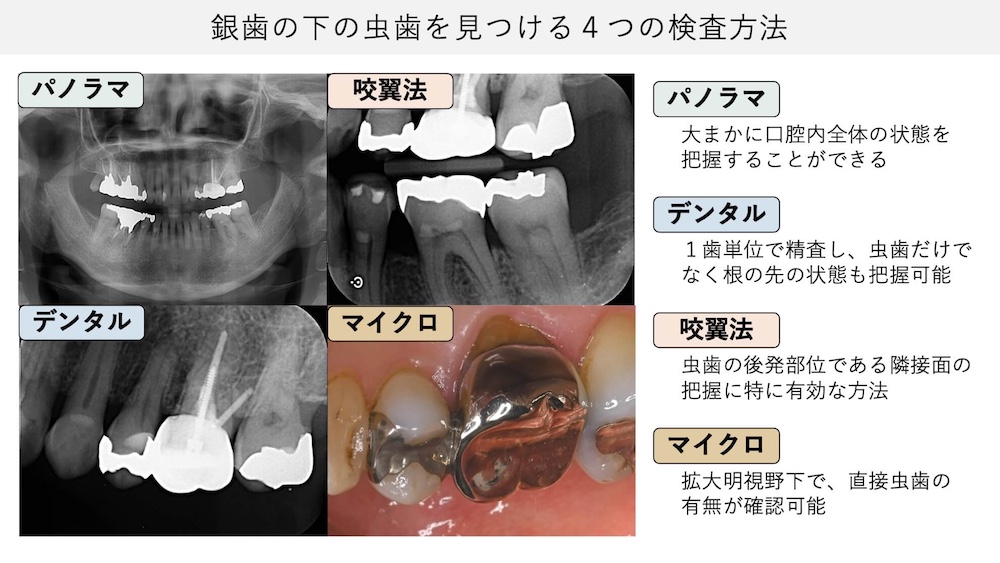 当院の虫歯の検査方法について