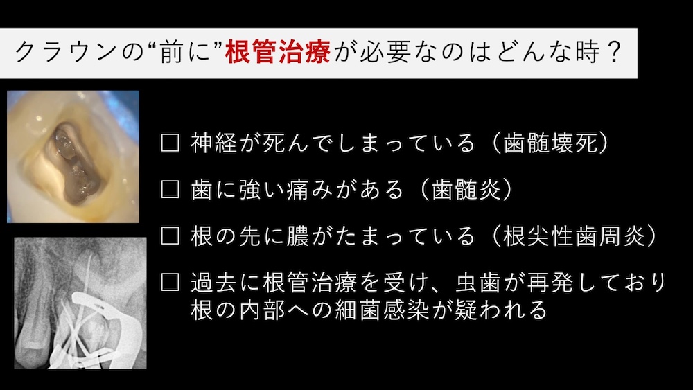 ②必要に応じて根管治療を実施