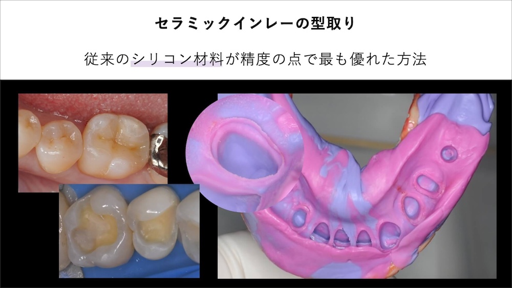 ③シリコン材料による精密な型取り