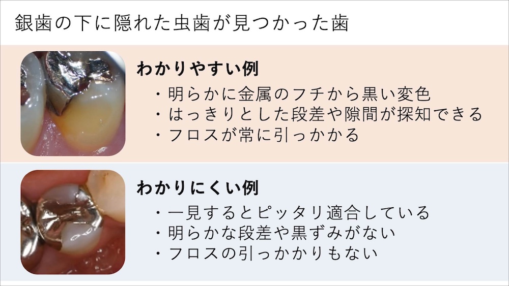銀歯の下の虫歯が見つけにくい理由