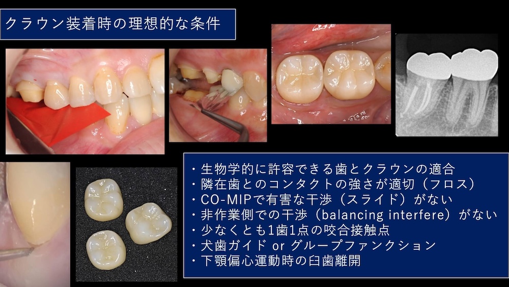 ⑥完成したセラミッククラウンを調整