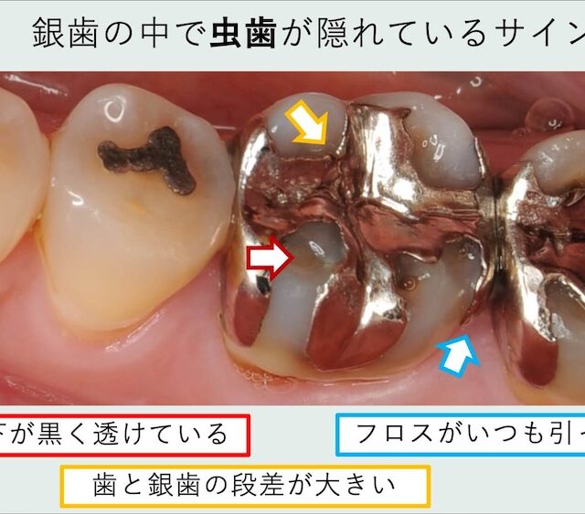 こんなサインは要注意：銀歯の中で虫歯が進行しているケース