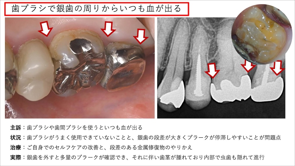 歯ブラシで銀歯の周りからいつも血が出る