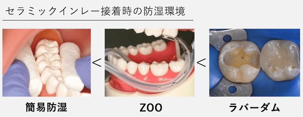 ④完成したセラミックをラバーダム防湿下で接着