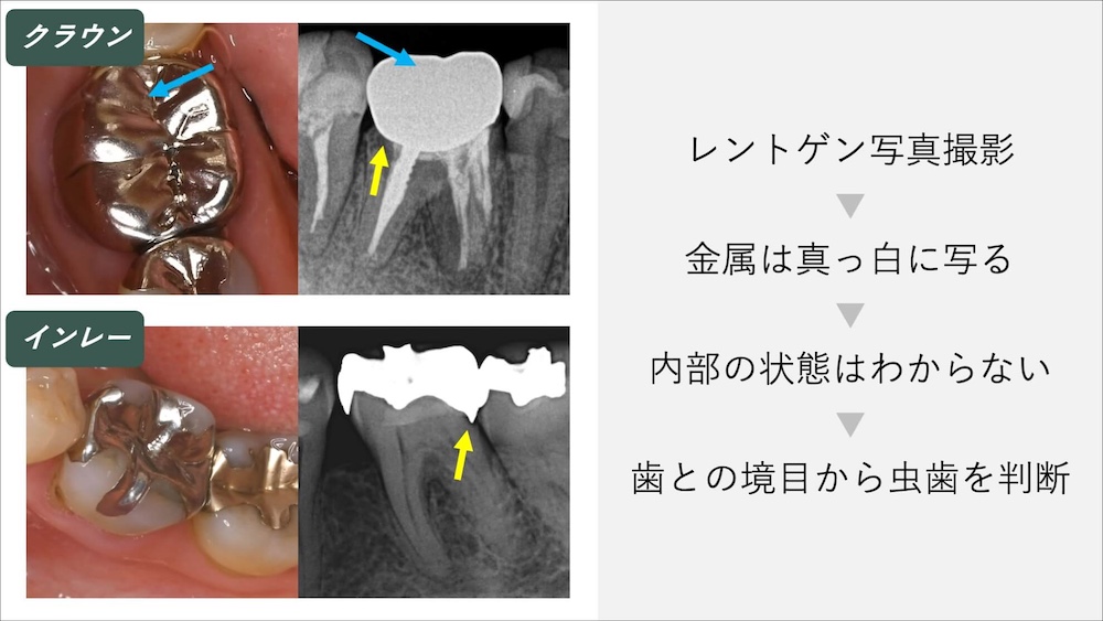 レントゲンで見える場合はすでにかなり進行している
