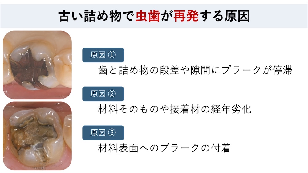 詰め物の下で虫歯が再発している(二次う蝕)