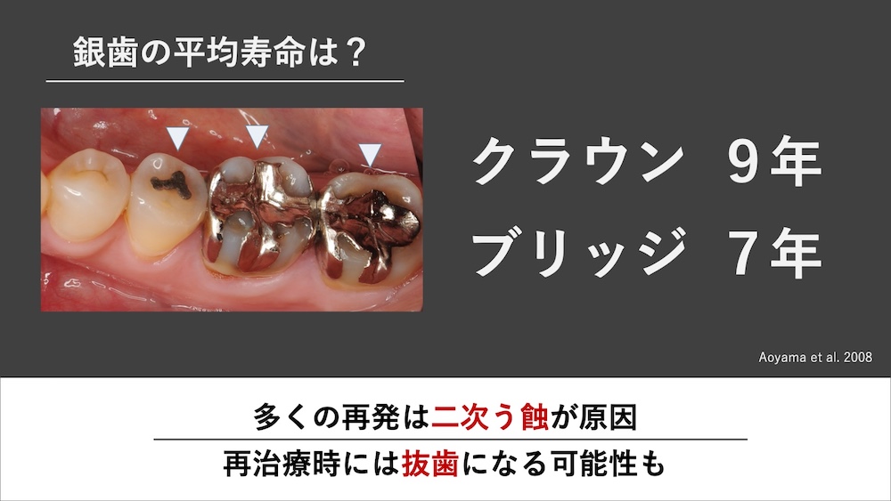 銀歯やレジンの平均寿命は長くない