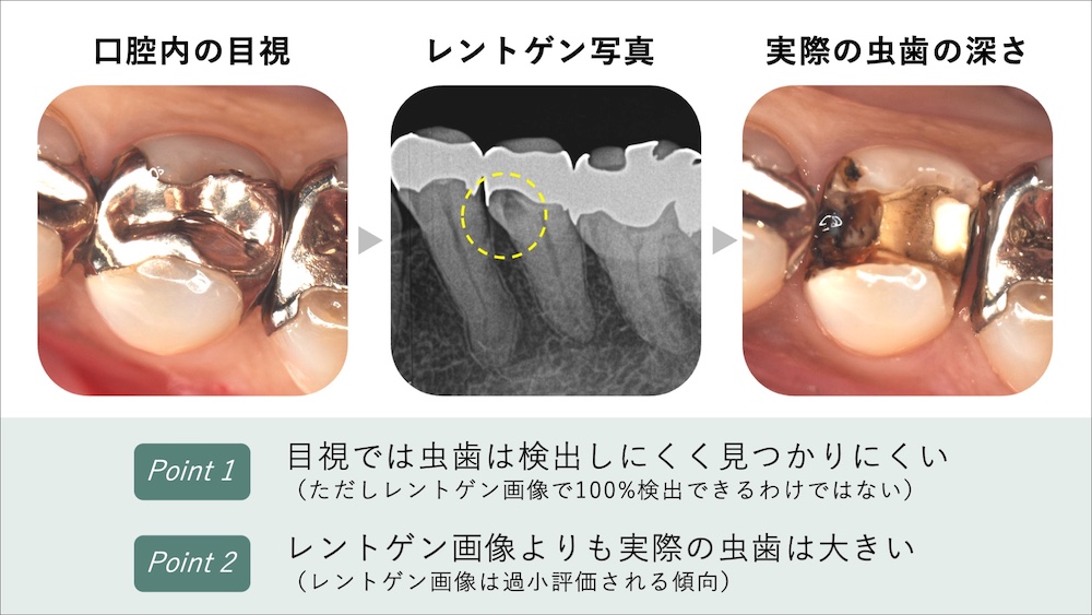 二次う蝕が発見されにくい理由