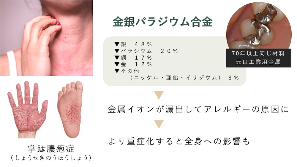 金属アレルギーのリスクがない