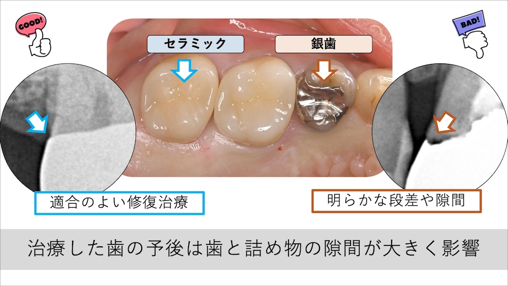 セラミックの高い接着力が隙間を作らない
