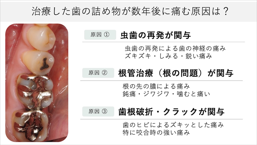詰め物をした歯が数年後に痛む主な原因