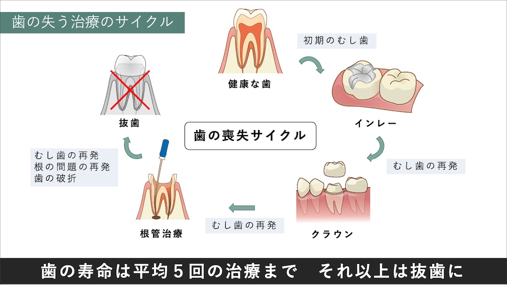 何度も再治療を繰り返さないための治療選択