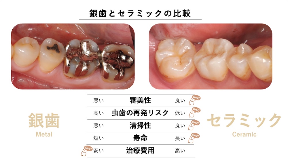 材料と治療精度の違いが予後を左右する