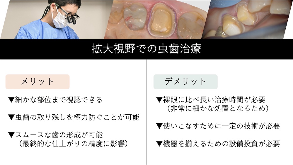 マイクロスコープによる徹底した虫歯の除去