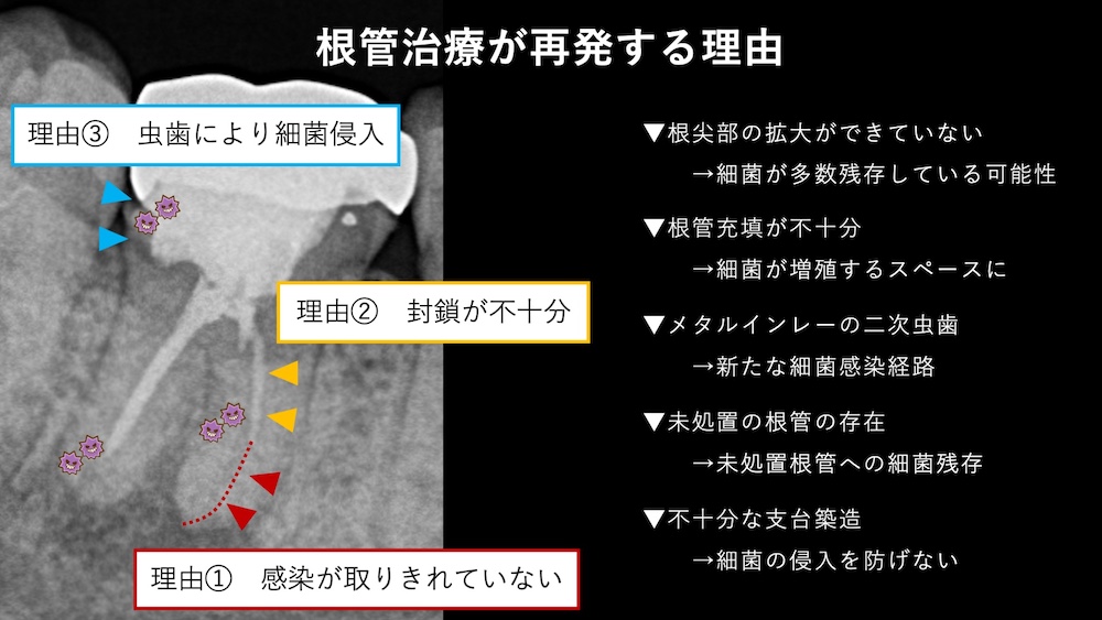 根管治療が不完全だった場合