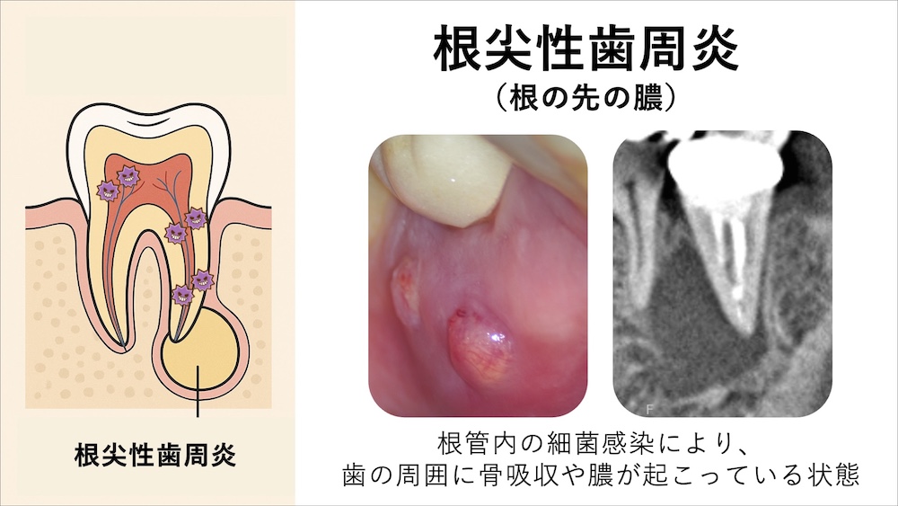 歯の根の先に膿が溜まっている(根尖性歯周炎)