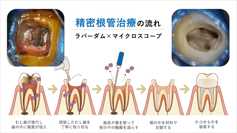 精密な根管治療で再感染を防ぐ