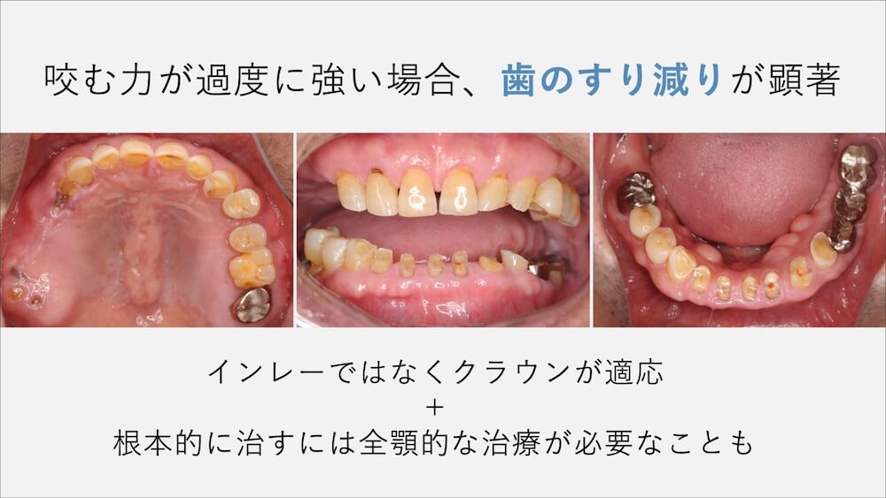 ④噛み合わせの力が強い／食いしばりがある