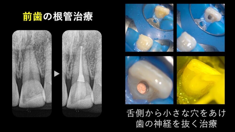 前歯はクラウンにならないケースも多い