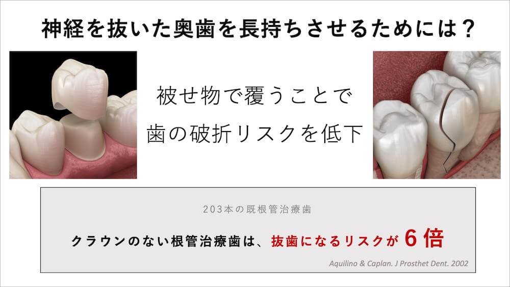 奥歯（小臼歯・大臼歯）はクラウンで「支える」
