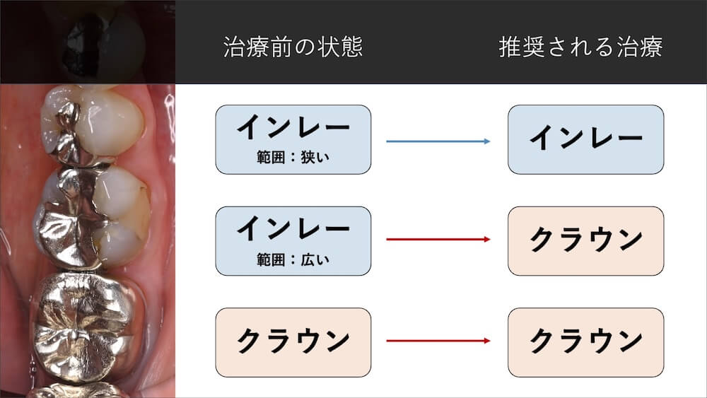②すでに大きい詰め物・被せ物が入っている