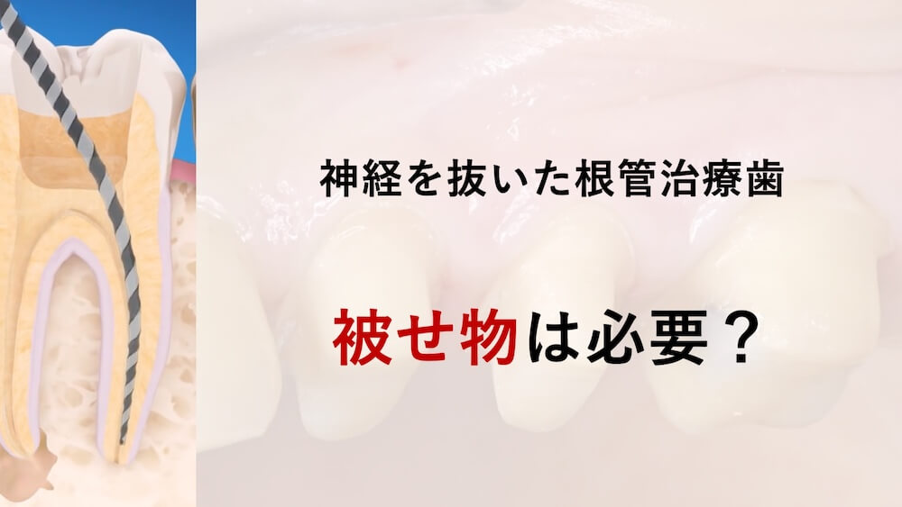 神経を抜いた歯は被せ物が必要？部位別（前歯・奥歯）の治療と素材の選び方、再発を防ぐ方法
