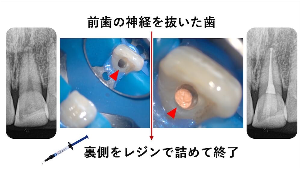 ①前歯などの強い咬合力がかかりにくい箇所