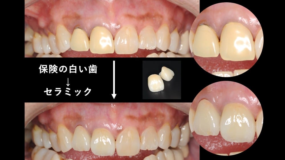 image_tooltip セラミック