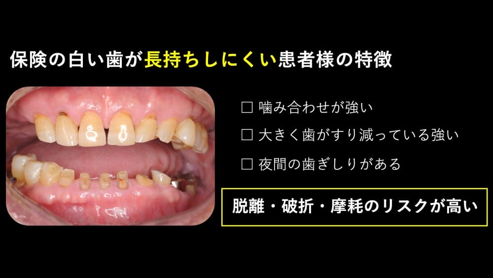 image_tooltip 保険の白い歯が長持ちしにくい患者様の特徴