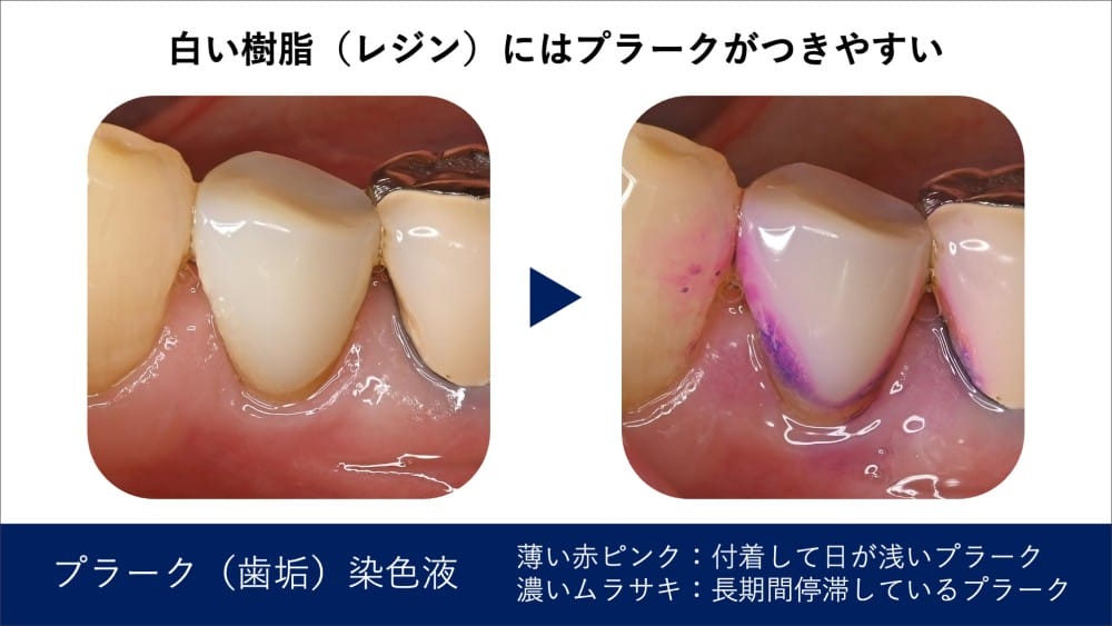 image_tooltip 保険の白い歯はプラークがつきやすい