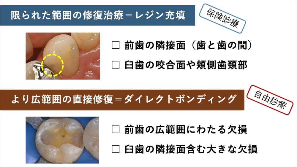 image_tooltip 小さめの虫歯の場合:詰め物(コンポジットレジン)
