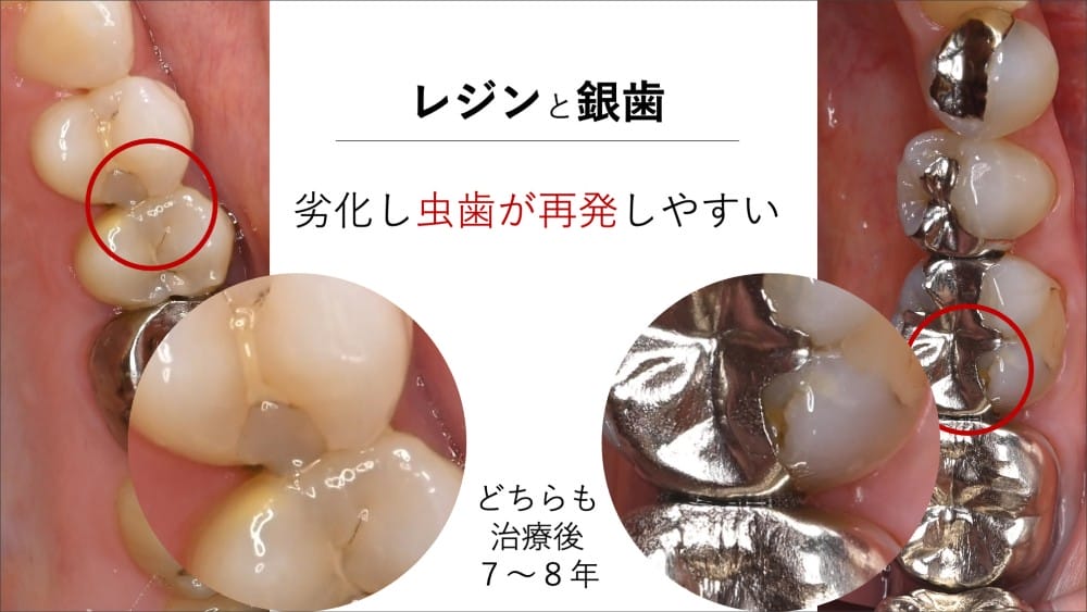 image_tooltip レジンと銀歯
