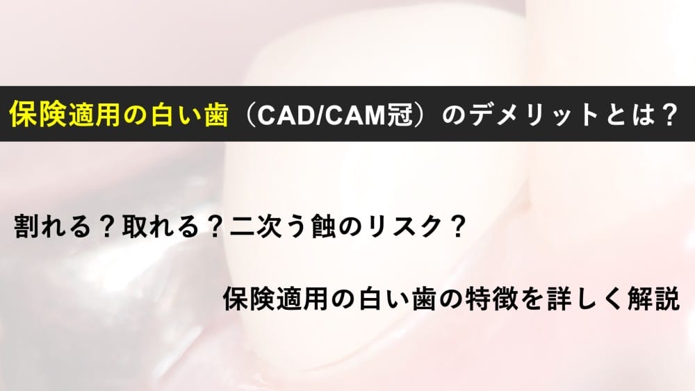 image_tooltip 保険適用の白い歯(CAD/CAM冠)のデメリット|割れる・外れる・虫歯の再発を避けたい方へ