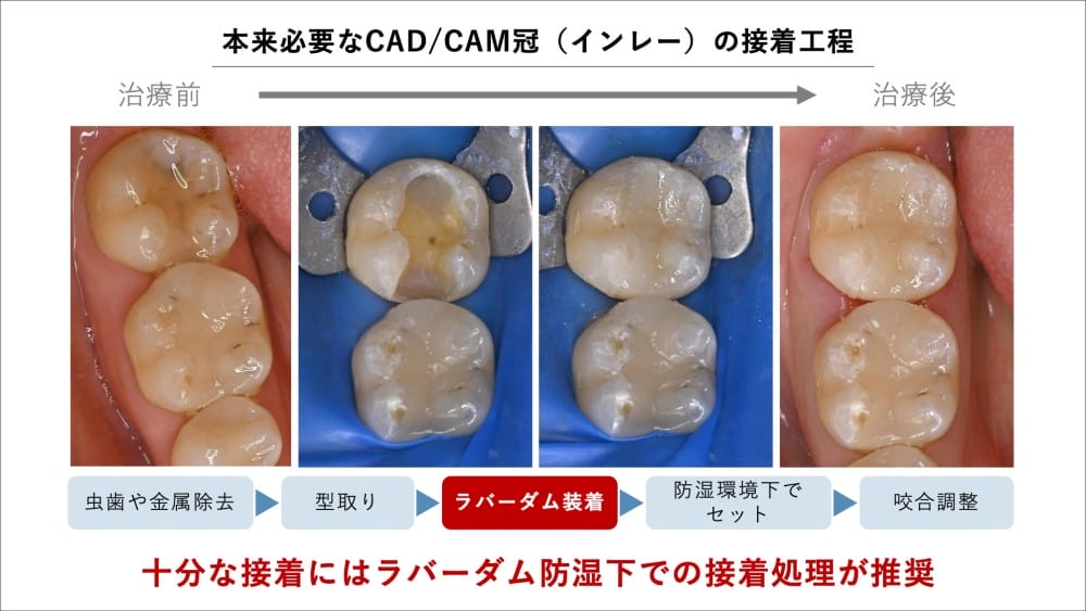 image_tooltip 本来必要なCAD/CAM冠の接着工程
