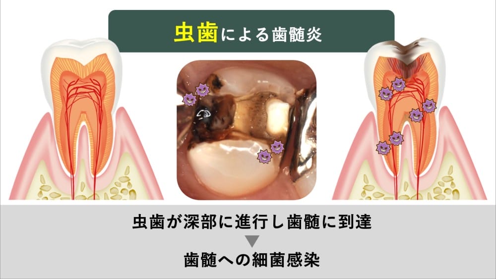 image_tooltip 虫歯による歯髄炎