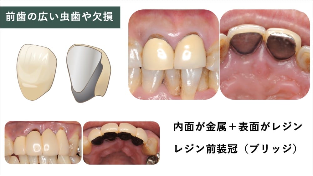 image_tooltip 前歯の大きな虫歯:レジン前装金属冠など