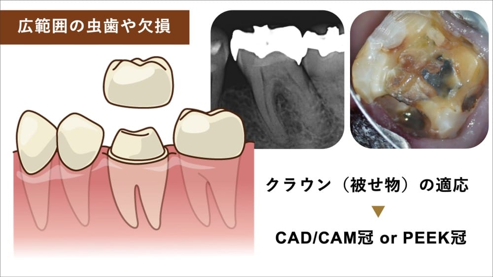 image_tooltip 大きな虫歯の場合:被せ物(CAD/CAM冠・PEEK冠)