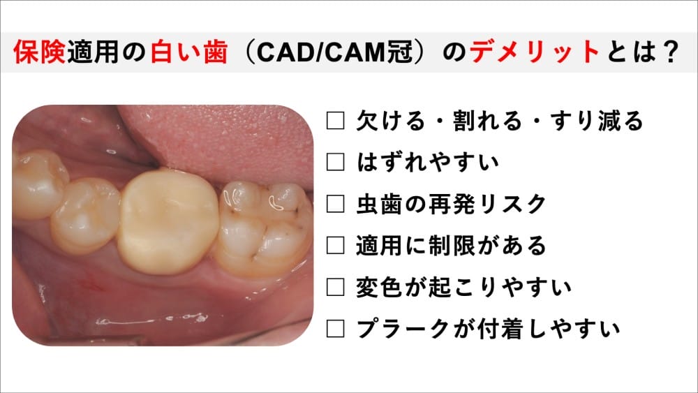 image_tooltip 保険適用の白い歯のデメリット