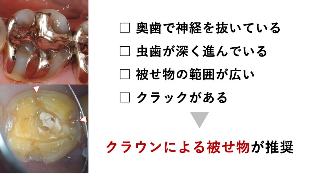 image_tooltip クラウンによる被せ物を推奨する場合