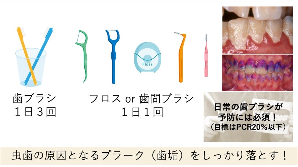 正しい歯磨きとフロス・歯間ブラシの活用でプラークをしっかり落とす