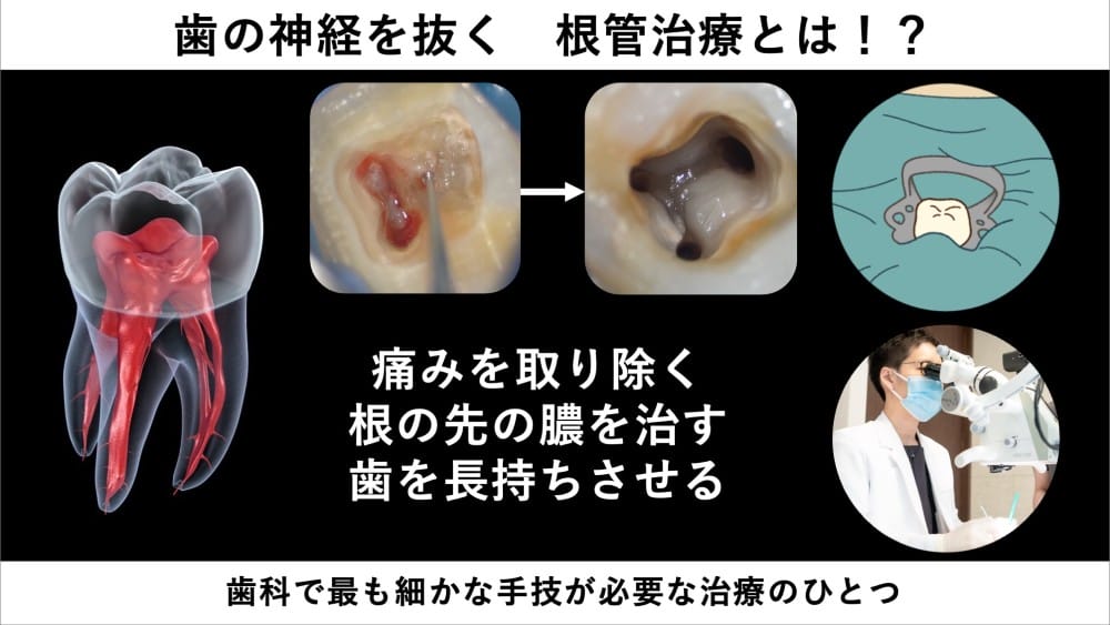 歯の神経を抜く　根管治療とは