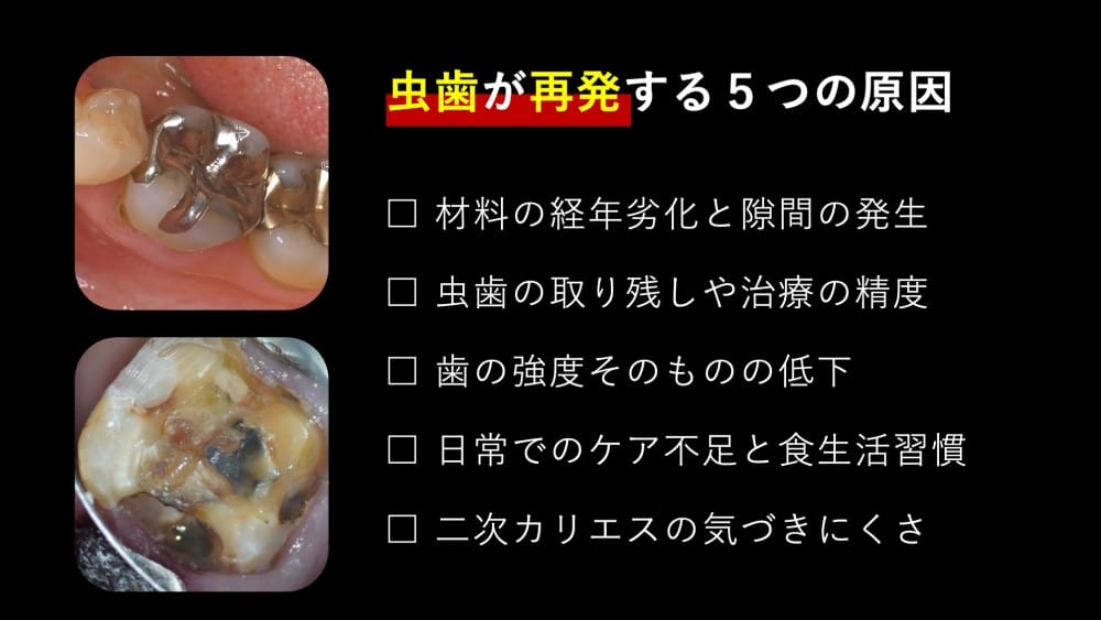 虫歯が再発する5つの原因｜なぜ治療した歯がまた虫歯になるのか