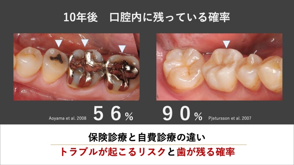 虫歯再発の確率｜銀歯の10年後生存率は約50%