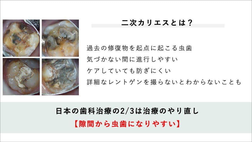 虫歯の再発「二次カリエス」とは？治療した歯がまた虫歯になる仕組み